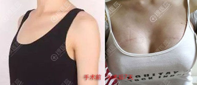 湘潭雅美假体隆胸术前术后对比图