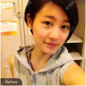 <!--<i data=20240710 data-id=10622></i>-->双眼皮案例术前照片