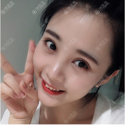 <!--<i data=20240710 data-id=10622></i>-->医美朱小平做的双眼皮案例