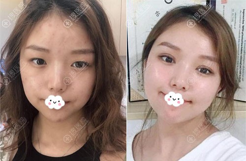 <!--<i data=20240710 data-id=12057></i>-->晶钻翘睫眼综合双眼皮术前术后效果对比图