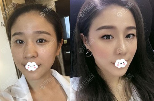 <!--<i data=20240710 data-id=12057></i>-->自体肋软骨隆鼻综合整形术前术后效果对比图