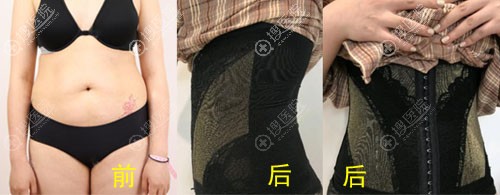 <!--<i data=20240710 data-id=12057></i>-->吸脂真人案例对经图片