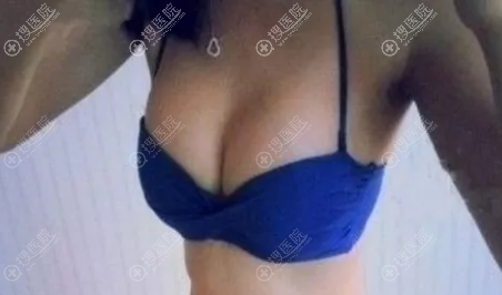 <!--<i data=20240710 data-id=12764></i>-->假体丰胸术后泳照