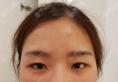 韩国纯真医院隆鼻和双眼皮手术是这么做的,崔宰源院长技术真棒