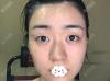 看我真实案例恢复对比图了解广州曙光注射瘦脸针效果好不好？