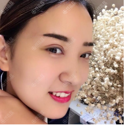 洛阳爱尚整形李冉双眼皮案例7天自拍