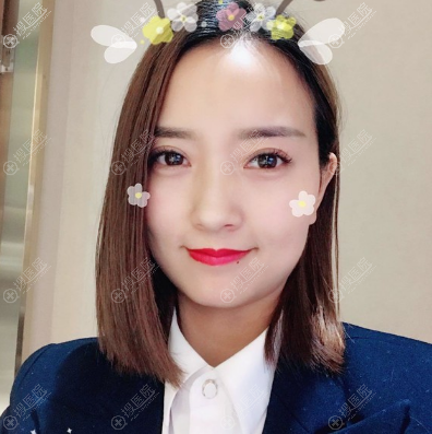 洛阳爱尚整形李冉院长双眼皮案例