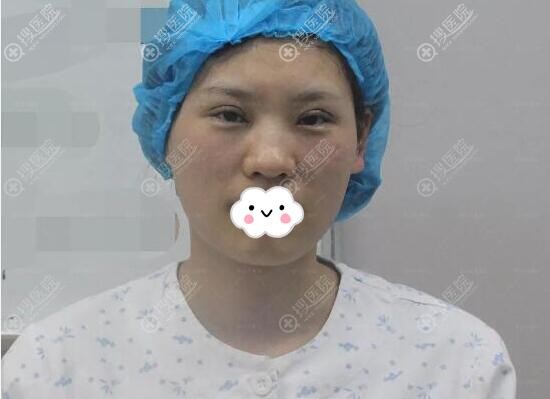 侯舍予双眼皮手术即刻照片