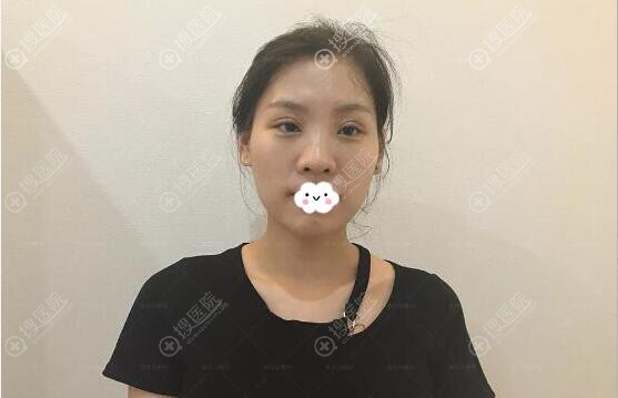切开双眼皮术后7天恢复情况