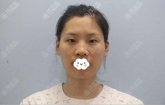 贴双眼皮贴导致眼皮松弛