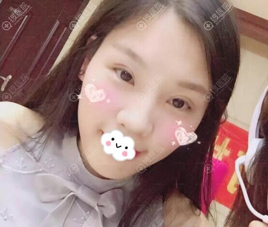 贵阳美贝尔侯舍予双眼皮手术3个月