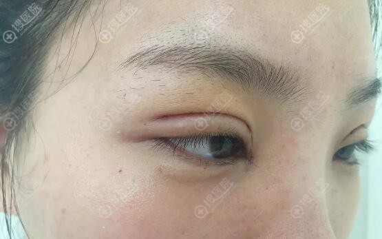 六度美眼术后3天眼部特写