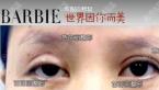 南宁芭芘丽整形失败双眼皮修复案例术后恢复对比图&附优惠价格