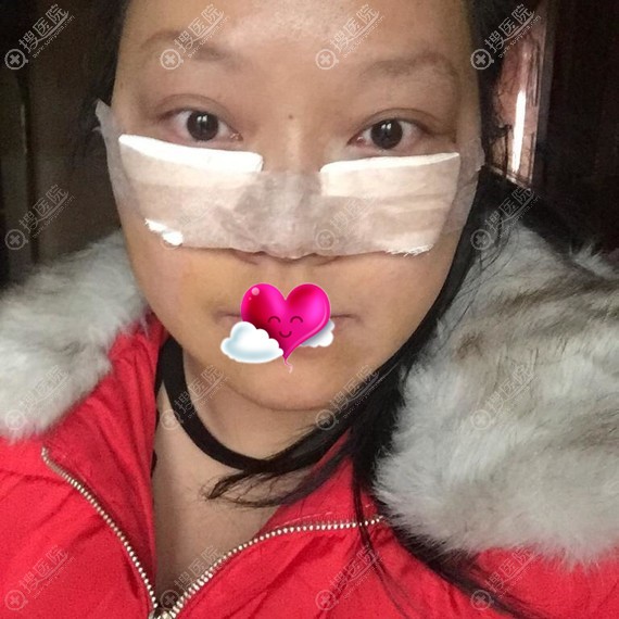 芜湖伊莱美内路祛眼袋术后