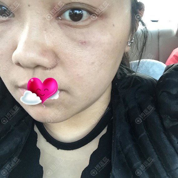 芜湖伊莱美内路祛眼袋3天的效果