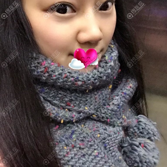 芜湖伊莱美<!--<i data=20240710 data-id=17317></i>-->内路祛眼袋恢复效果