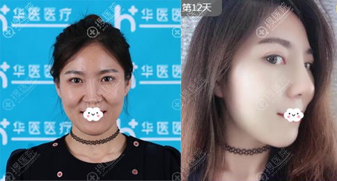 呼和浩特华医赵彦波膨体隆鼻真人案例 呼和浩特华医赵彦波膨体隆鼻真人案例