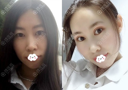 呼和浩特华医赵彦波切开双眼皮案例前后对比图 呼和浩特华医赵彦波切开双眼皮案例前后对比图