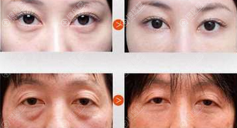 呼和浩特华医去眼袋案例前后对比图 呼和浩特华医去眼袋案例前后对比图