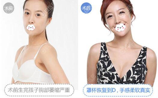 呼和浩特华医自体脂肪隆胸案例对比图 呼和浩特华医自体脂肪隆胸案例对比图
