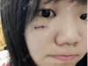 脸上留疤后我去上海虹桥医院疤痕科找单兴柱做了面部疤痕去除