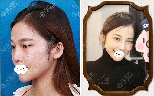 深圳美莱假体隆鼻失败修复案例