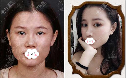 深圳美莱双眼皮+上睑下垂矫正案例