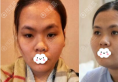 分享深圳回来医疗美容高卿豪脂肪面部填充术后2个月案例效果