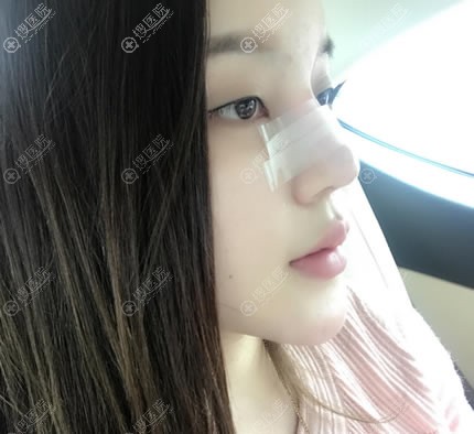 北京薇琳整形隆鼻失败修复案例