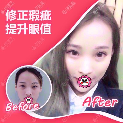 广州紫馨曹仁昌眼部修复 广州紫馨曹仁昌眼部修复