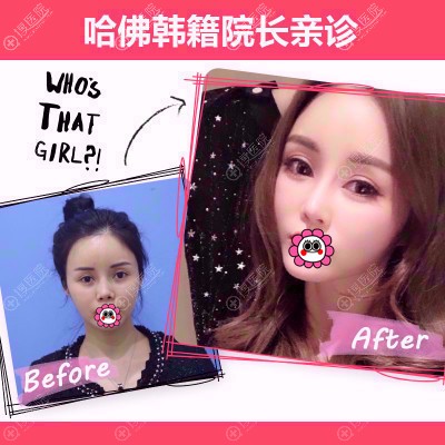 金孝宪鼻部整形效果 金孝宪鼻部整形效果