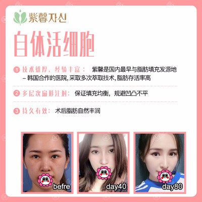 郑宰昊面部脂肪填充 郑宰昊面部脂肪填充