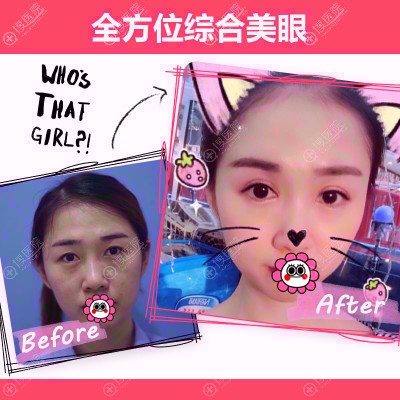 洪星杓眼综合案例 洪星杓眼综合案例