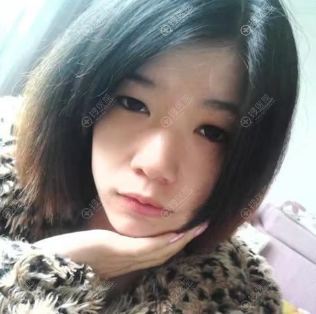 东莞维多利亚做隆鼻和双眼皮前