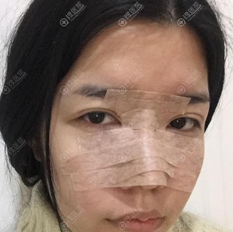 东莞维多利亚<!--<i data=20240710 data-id=17555></i>-->勇隆鼻案例即刻效果