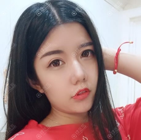 东莞维多利亚隆鼻和双眼皮案例