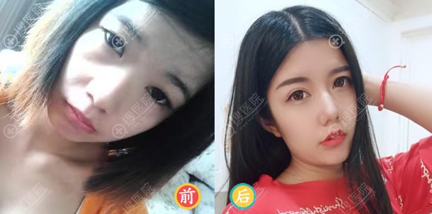 东莞维多利亚假体隆鼻案例对比图