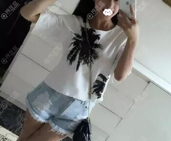 假体丰胸手术前照片