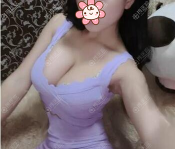 假体隆胸术后半年效果展示