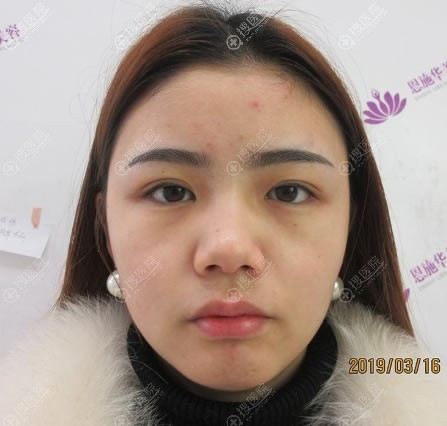 <!--<i data=20240710 data-id=11909></i>-->做肋软骨隆鼻手术前