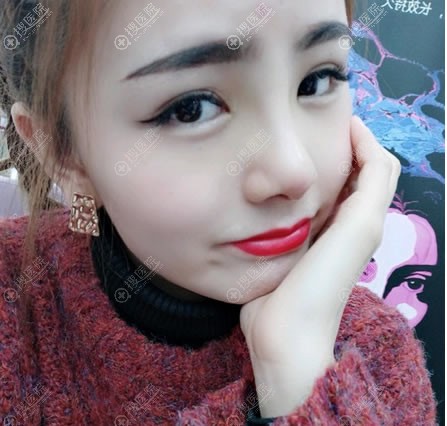 <!--<i data=20240710 data-id=11909></i>-->肋软骨隆鼻7天拆线效果