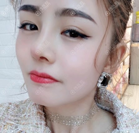 <!--<i data=20240710 data-id=11909></i>-->假体隆鼻案例15天效果