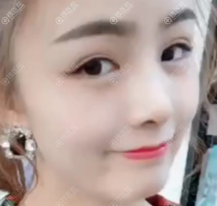 <!--<i data=20240710 data-id=11909></i>-->陈为民隆鼻案例30天效果