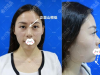 深圳富华李秀林3支玻尿酸隆鼻丰下巴改变脸部轮廓附术后对比图