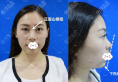 深圳富华李秀林3支玻尿酸隆鼻丰下巴改变脸部轮廓附术后对比图