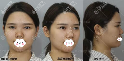 深圳阳光整形韩国医生朴在久做的膨体鼻综合术后效果超级适合我 假体隆鼻 搜医院 深圳阳光整形韩国医生朴在久做的膨体鼻综合术后效果超级适合我 假体隆鼻 搜医院