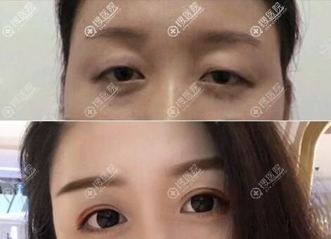 <!--<i data=20240710 data-id=8260></i>-->黄中志割双眼皮案例