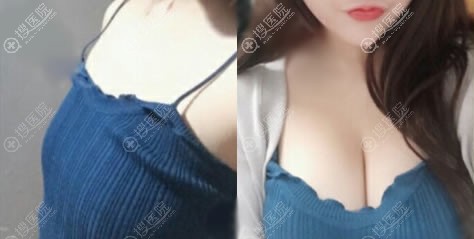 <!--<i data=20240710 data-id=8260></i>-->黄中志自体脂肪丰胸案例