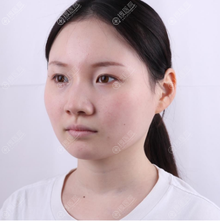 在上海华美做射频溶脂瘦脸前的照片