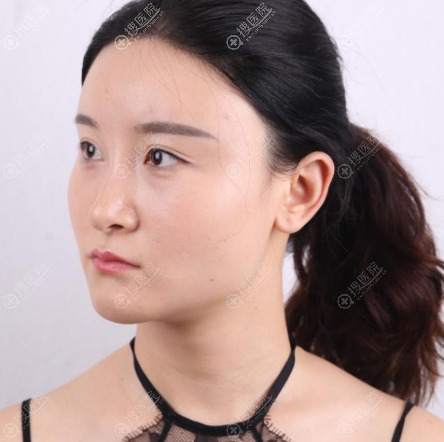 在上海华美做下颌角颧骨术前照片